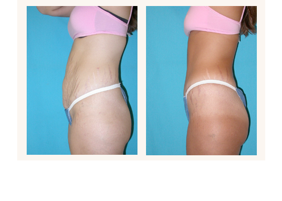 Abdominoplasty before and after photos