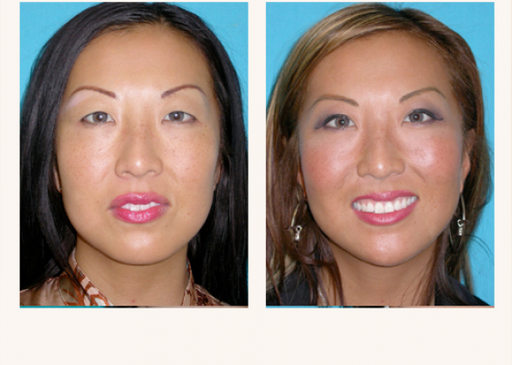 Asian eyelids before and after photos