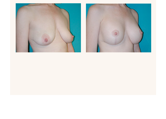 Breast augmentation before and after photos