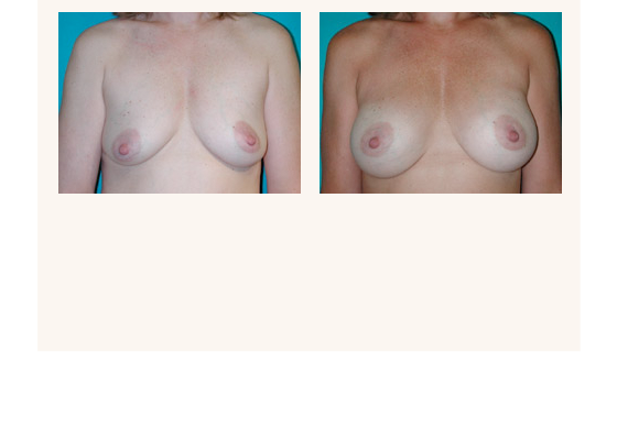 breastaugmentation3