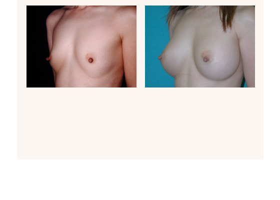 Breast augmentation before and after photos