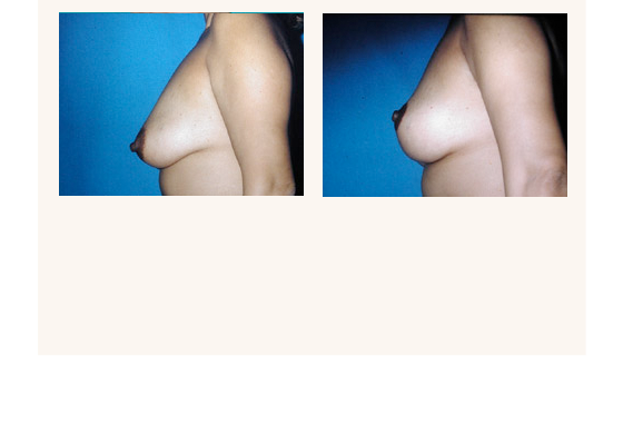 Breast lift before and after photos