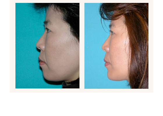 Chin surgery before and after photos