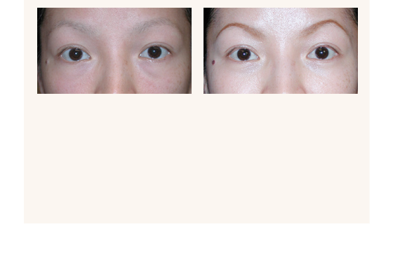 Eyelid surgery before and after photos
