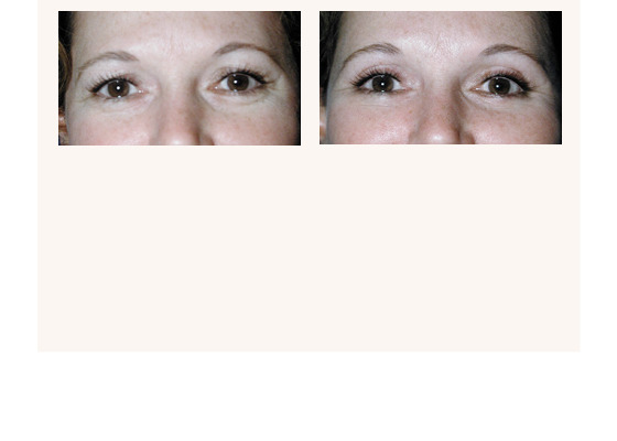 Eyelid surgery before and after photos
