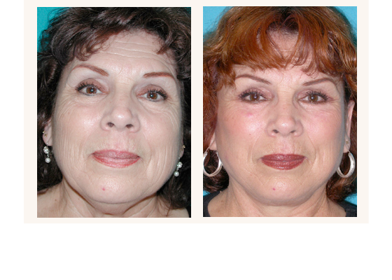Facelift before and after photos
