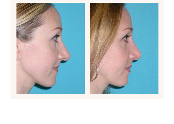 Nose surgery before and after photos