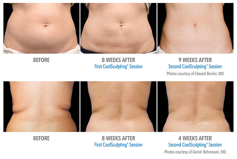 coolsculpting-before-after